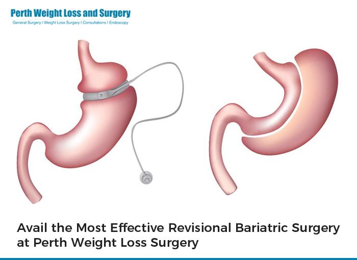 Avail the Most Effective Revisional Bariatric Surgery at Perth Weight Loss Surgery