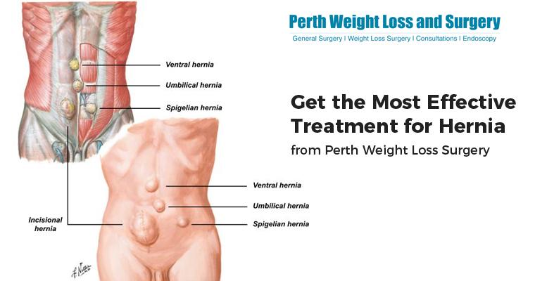Get the Most Effective Treatment for Hernia from Perth Weight Loss Surgery