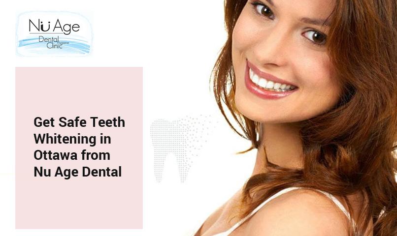 Get Safe Teeth Whitening in Ottawa from Nu Age Dental